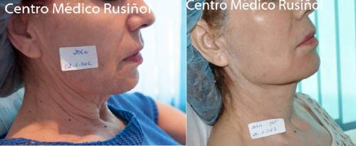 Lifting facial sin cirug�a